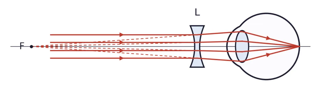 Eye with a lens L in front and parallel rays, point F marked