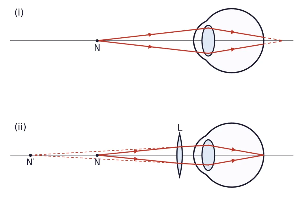 An eye with rays from point N, without and with lens L