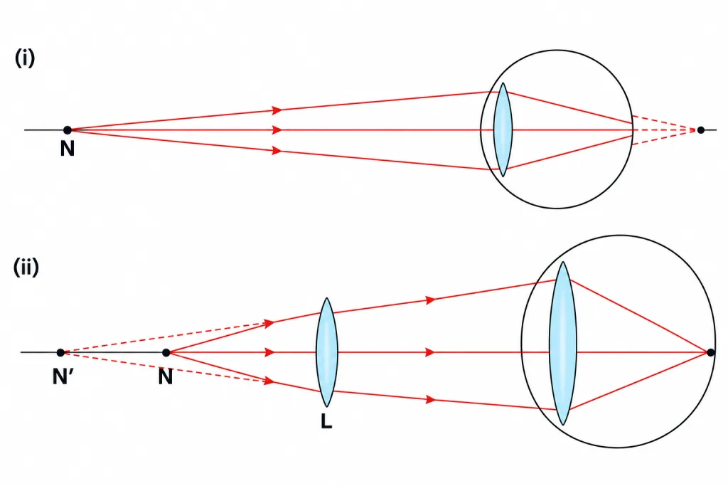 Two ray diagrams of an eye with points N, N′ and lens L