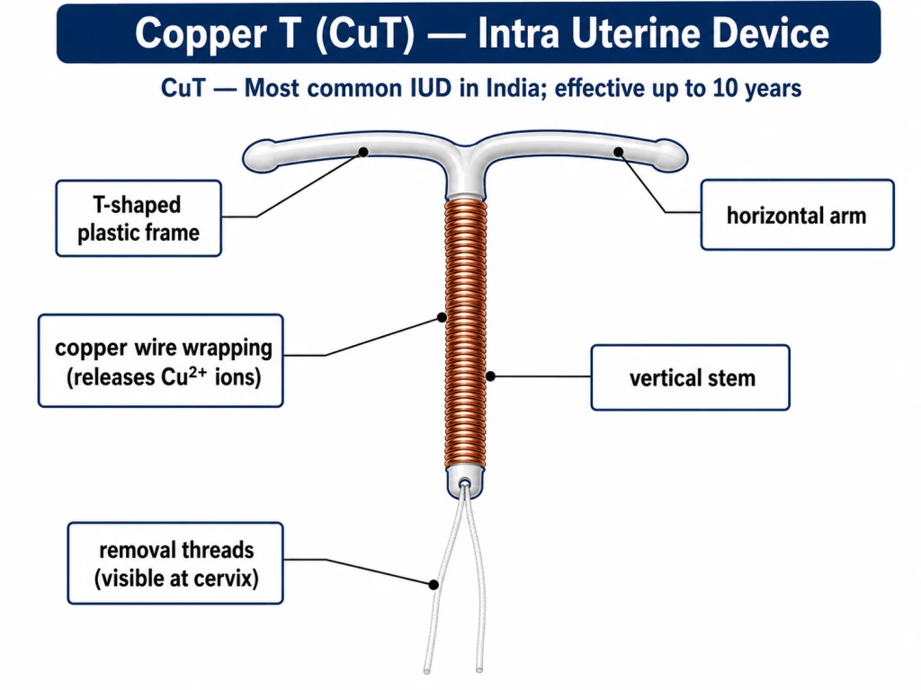 Labelled diagram of a Copper-T (CuT) intra-uterine device placed in the uterus