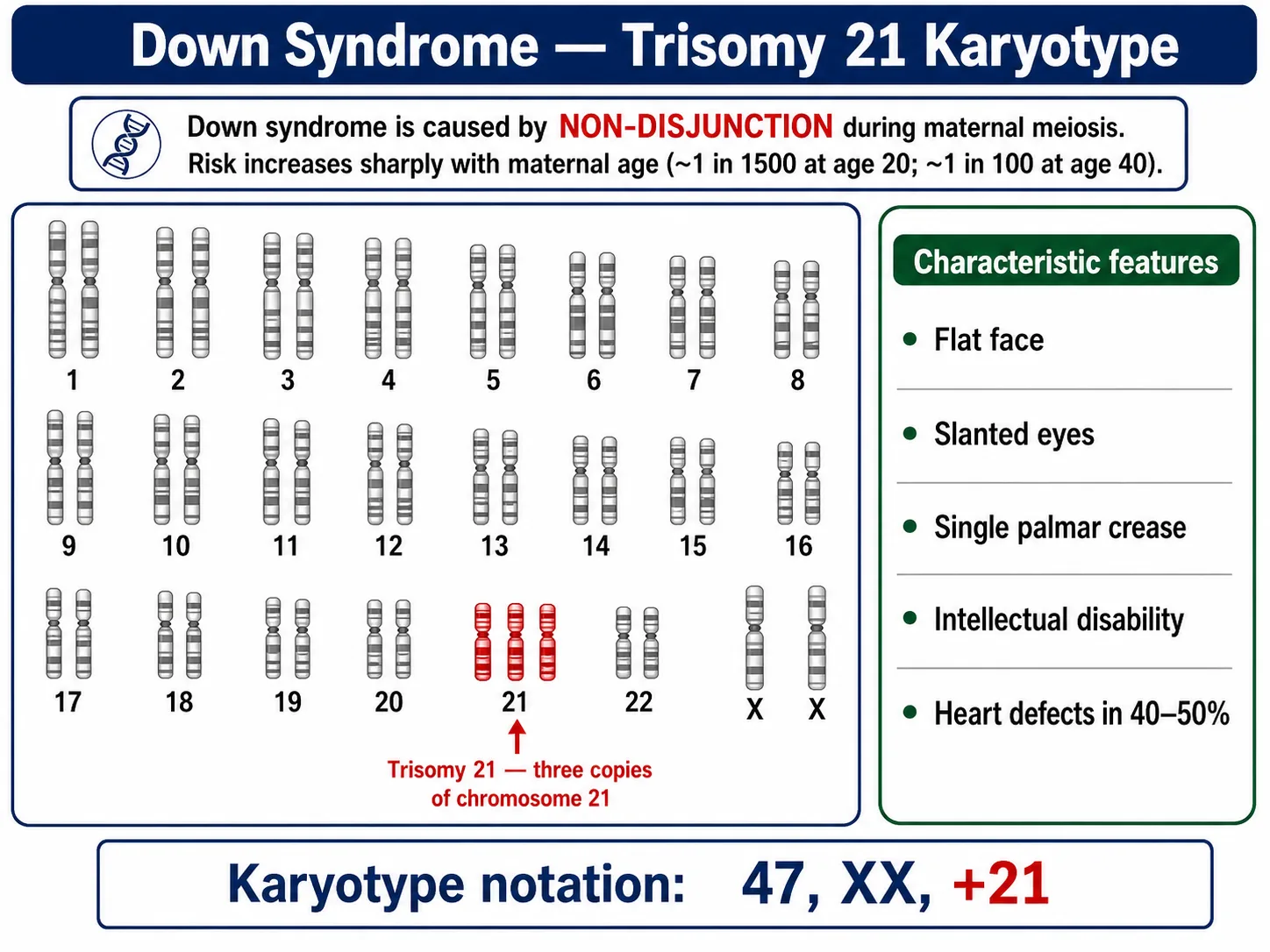 Down syndrome karyotype showing trisomy of chromosome 21